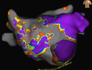 3D Voltage-Darstellung des linken Vorhofes bei einem Patienten mit fortgeschrittenem Vorhofflimmern